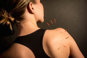 acupuncture needles in shoulder
