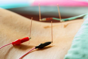electroacupuncture lower back