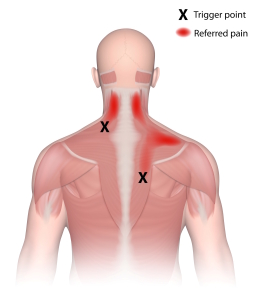 trigger point in trapezius