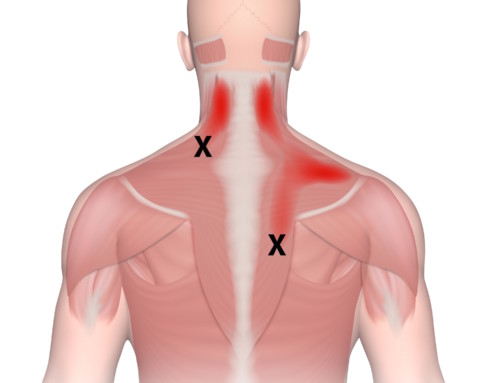 5 Things You Never Knew About Trigger Points