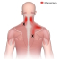 trigger point in trapezius